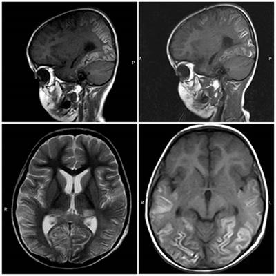 Case Report: Detection of SARS-CoV-2 From Cerebrospinal Fluid in a 34-Month-Old Child With Encephalitis